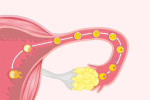 لماذا لا يحدث حمل رغم التبويض الجيد